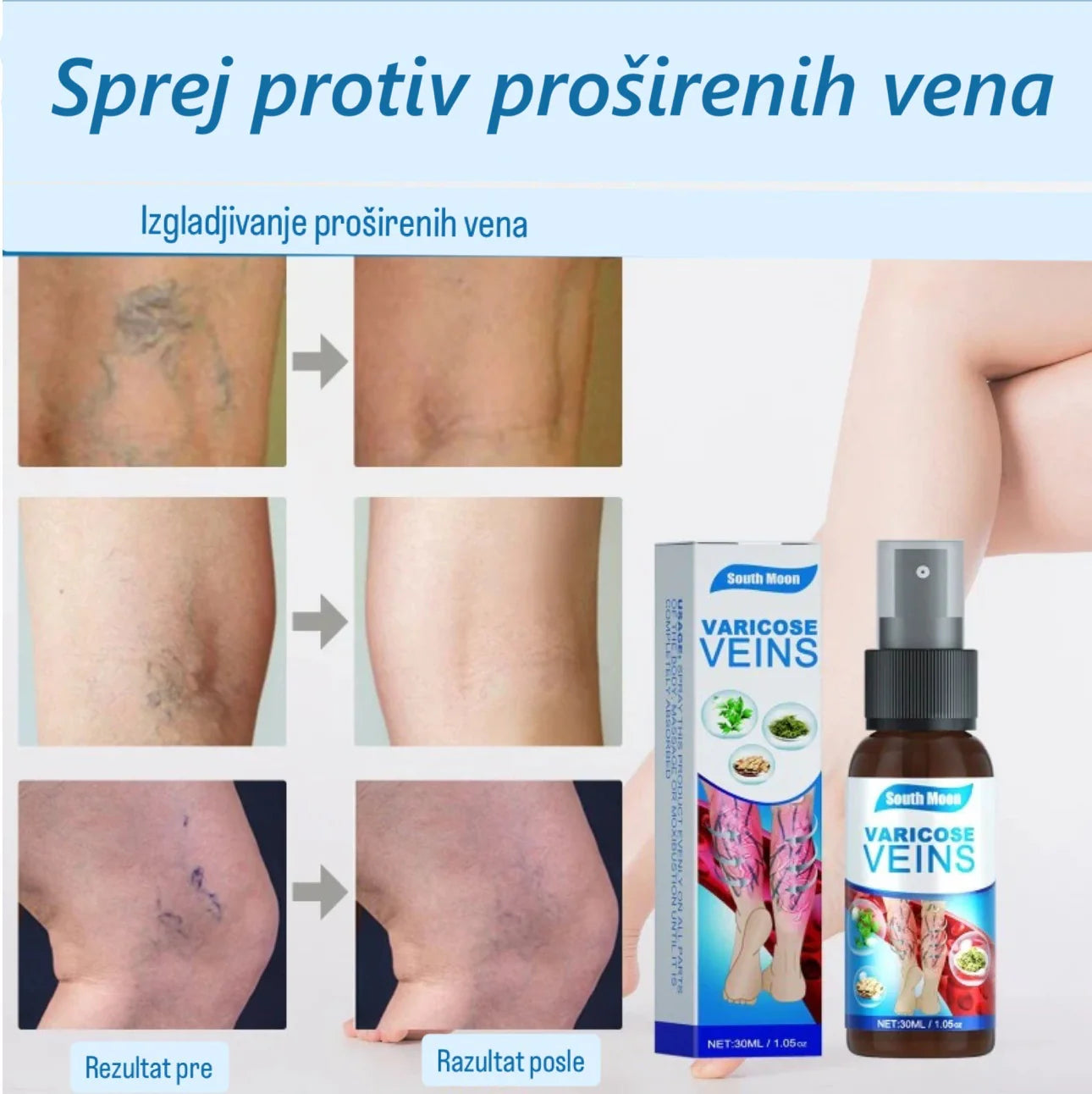 Prirodni sprej za proširene vene